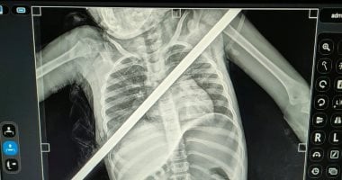 3 ساعات فى العمليات.. إنقاذ حياة طفلة اخترق سيخ حديد صدرها فى بنها الجامعى