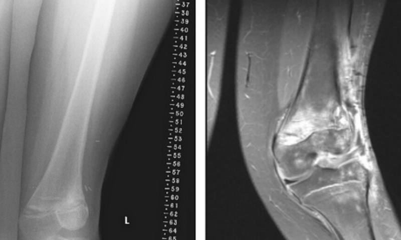 Knock knees in children: why it happens and when medical attention is required
