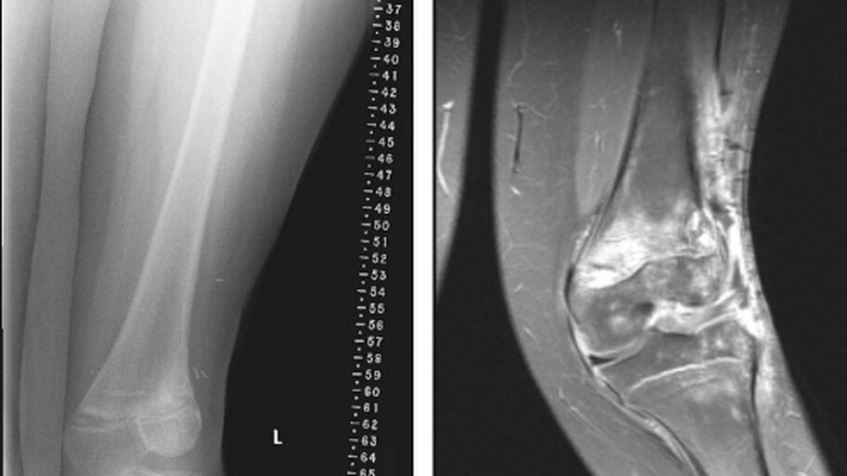 Knock knees in children: why it happens and when medical attention is required