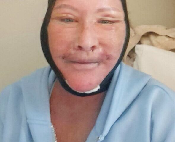 “Trolls said my £6k Turkey facelift was ‘done in a kebab shop’ but I love it”