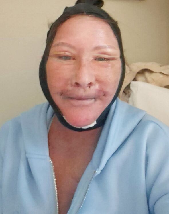 “Trolls said my £6k Turkey facelift was ‘done in a kebab shop’ but I love it”