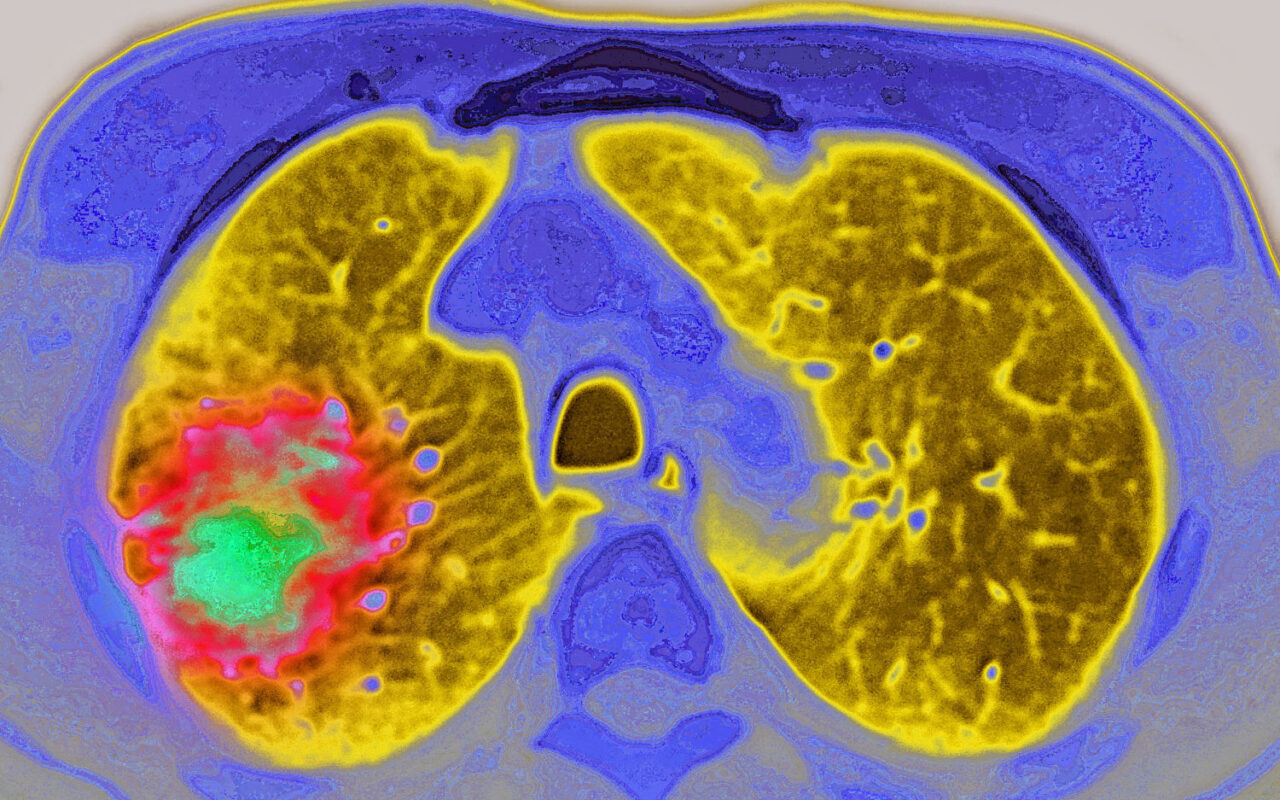 GLP-1 drugs may reduce the risk of cancer progressing, study suggests