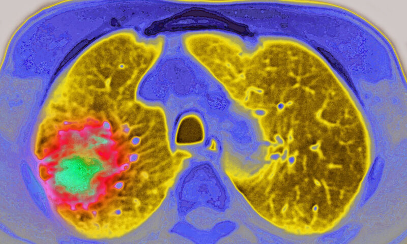 GLP-1 drugs may reduce the risk of cancer progressing, study suggests