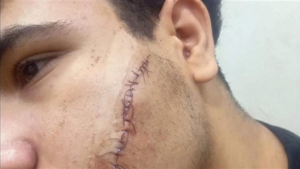 القصة الكاملة لإصابة طالب بـ 12 غرزة عقب الخروج من الامتحان في شبرا الخيمة بالقليوبية