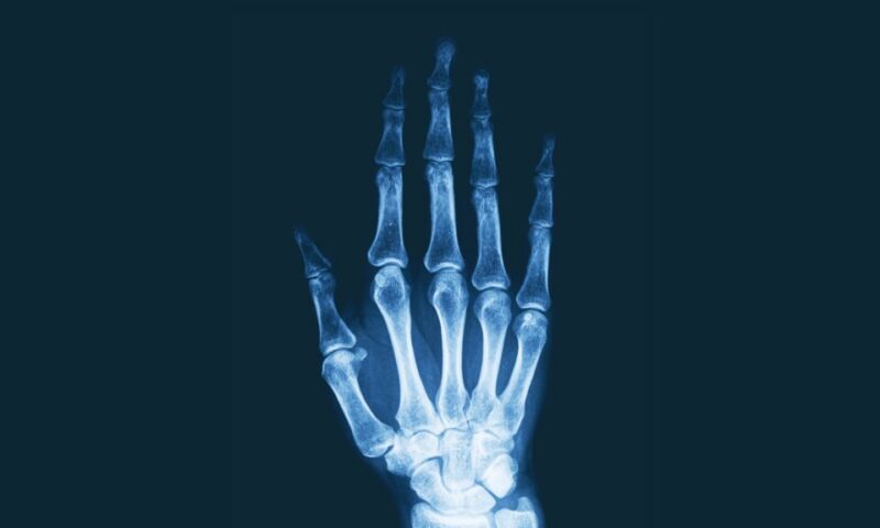 STAT+: Immunovant shares surge on arthritis trial data