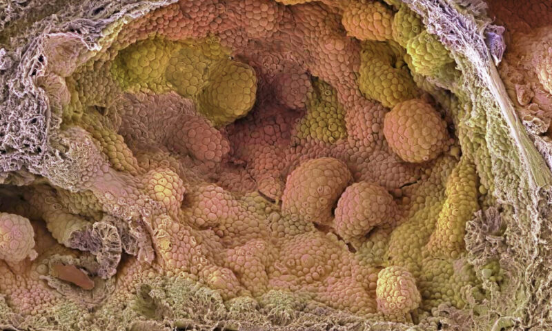 STAT+: For prostate cancer patients set on surgery, new hormone regimen may improve outcomes, study finds