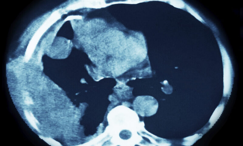 STAT+: Akeso and Summit’s ivonescimab extends survival in squamous cell lung cancer