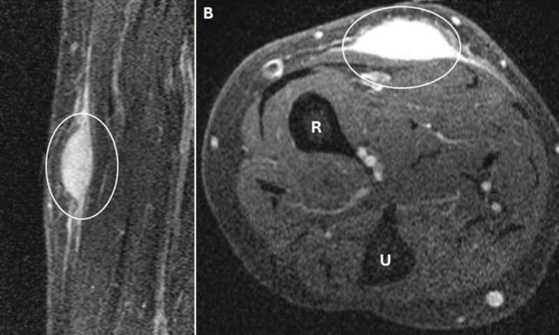 Diagnostic dilemma: Biopsy triggered ‘spontaneous regression’ of woman’s arm tumor