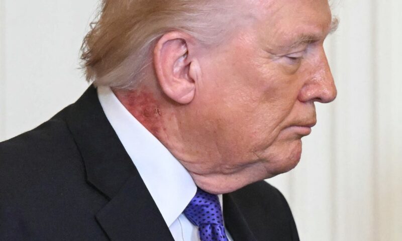 Trump’s latest health report says he needs to lose weight – but leaves out one notable medical issue