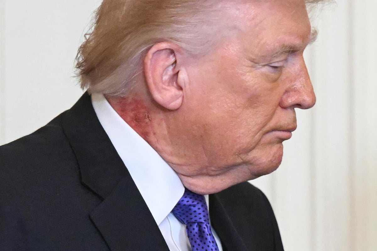 Trump’s latest health report says he needs to lose weight – but leaves out one notable medical issue