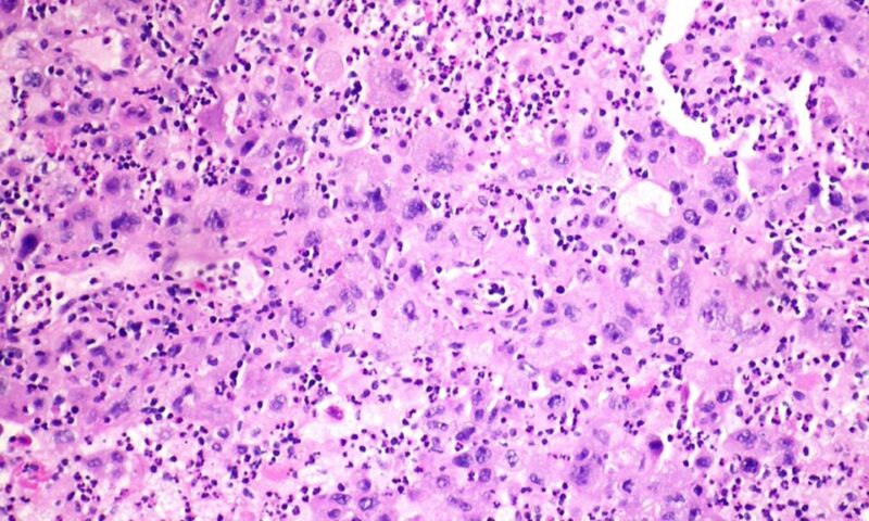 STAT+: Merck-Kelun lung cancer drug cut risk of tumor progression by 65%, ASCO abstract shows
