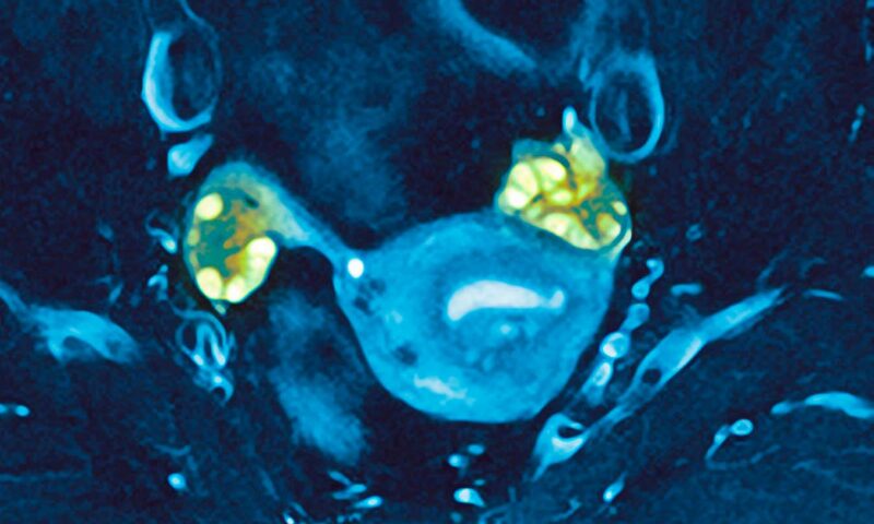 PCOS postpones perimenopause and allows pregnancies at older ages