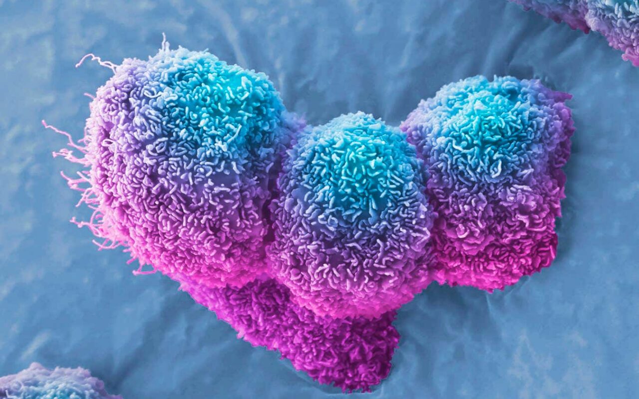 Pancreatic cancer halted by virus injection in three patients