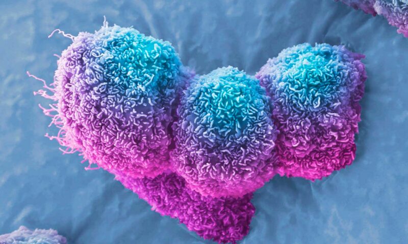 Pancreatic cancer halted by virus injection in three patients