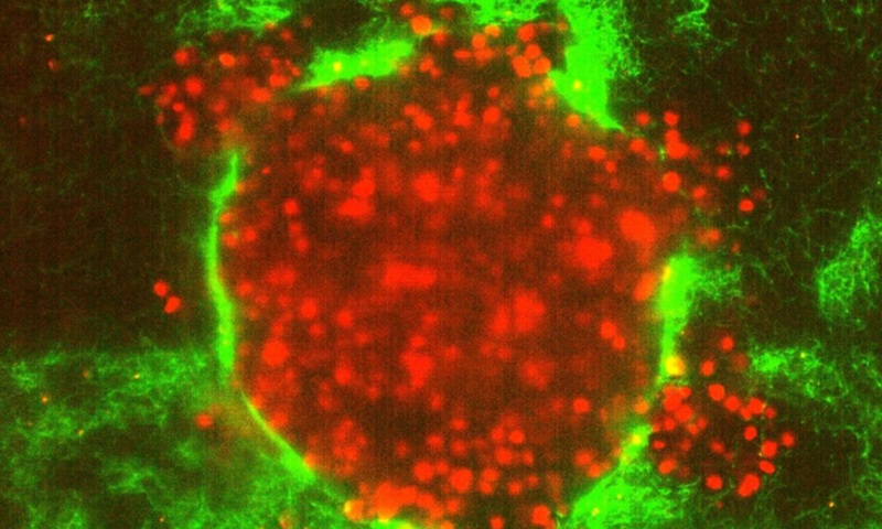 Studies reveal why some cancers are so much more dangerous than others