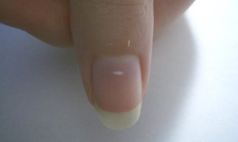 What changes in your nails may reveal about nutrition, trauma and chronic disease
