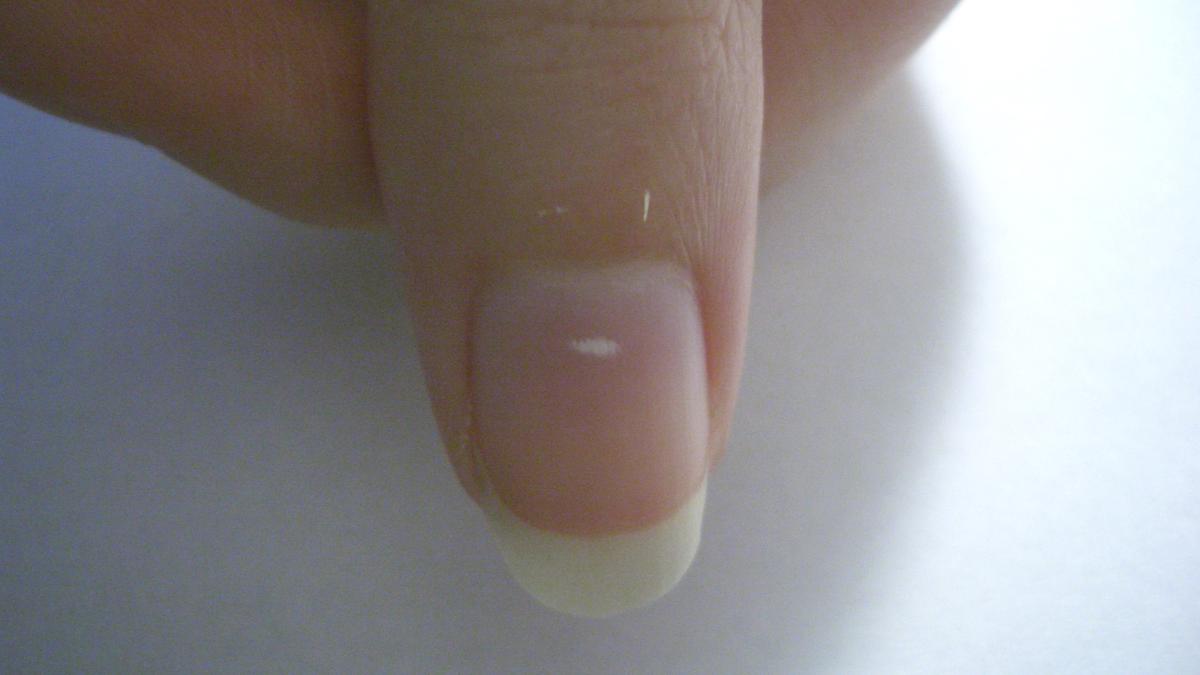 What changes in your nails may reveal about nutrition, trauma and chronic disease