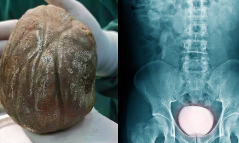 Chinese man who suffered painful urination for 3 years discovers 1.3kg stone in bladder