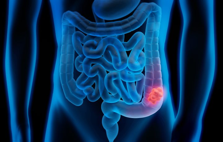 American Cancer Society recommends blood screening for colorectal cancer