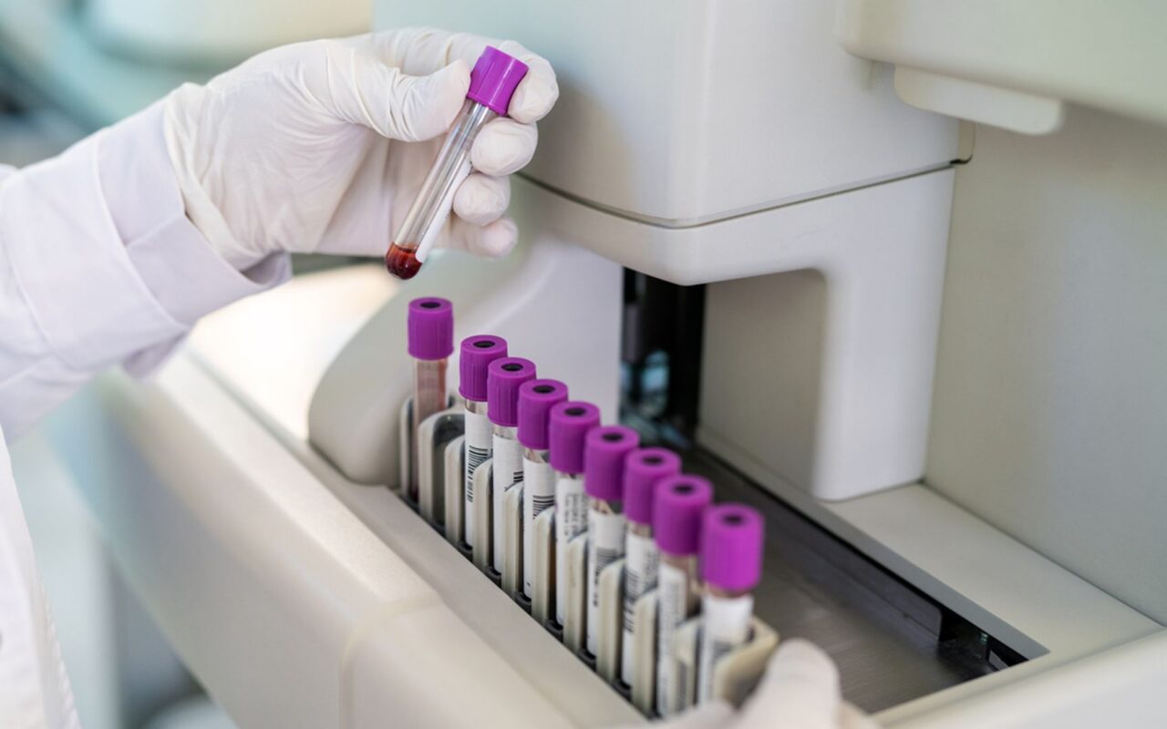 Blood test could detect Alzheimer’s signs ‘decades before symptoms appear’