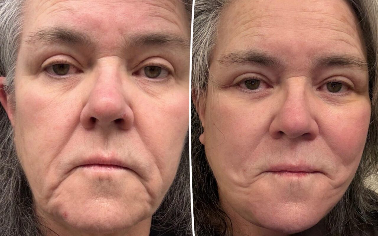 Rosie O’Donnell shares before-and-after facelift photos after undergoing ‘shameful’ procedure