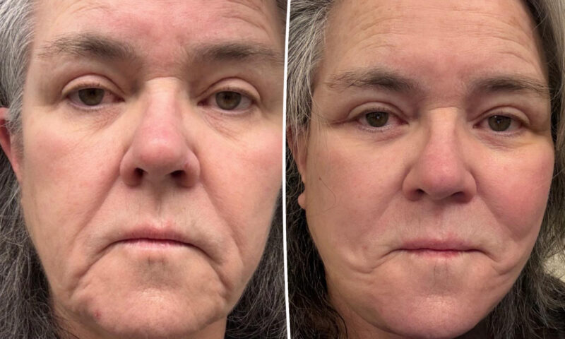Rosie O’Donnell shares before-and-after facelift photos after undergoing ‘shameful’ procedure
