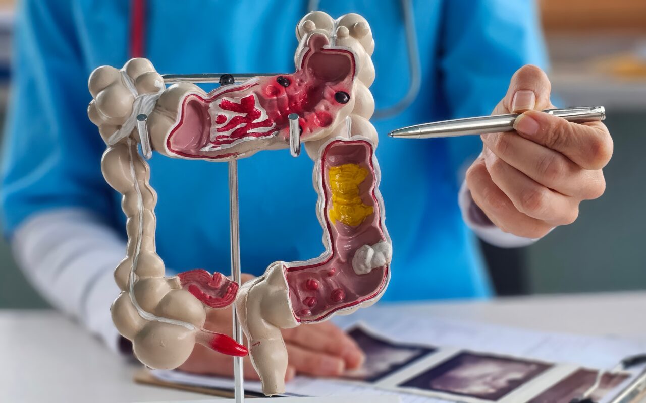 Doctors push new blood tests for colon cancer as cases surge in younger adults