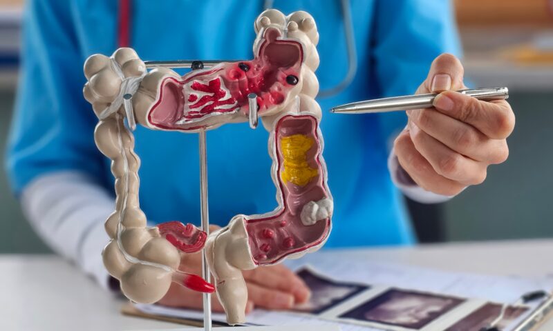 Doctors push new blood tests for colon cancer as cases surge in younger adults