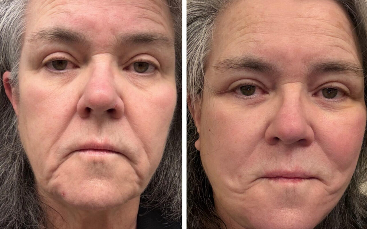 Rosie O’Donnell shares before-and-after facelift photos after undergoing ‘shameful’ procedure
