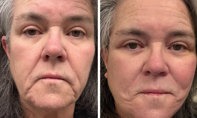 Rosie O’Donnell shares before-and-after facelift photos after undergoing ‘shameful’ procedure