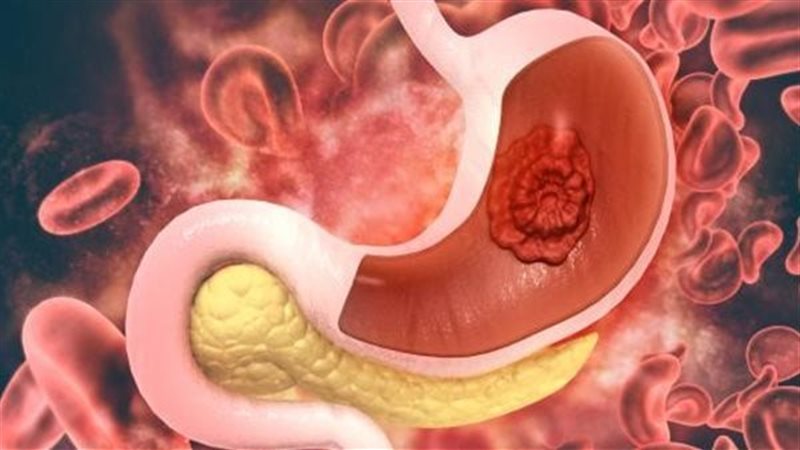 أعراض وأسباب التهاب جدار المعدة وطرق الوقاية