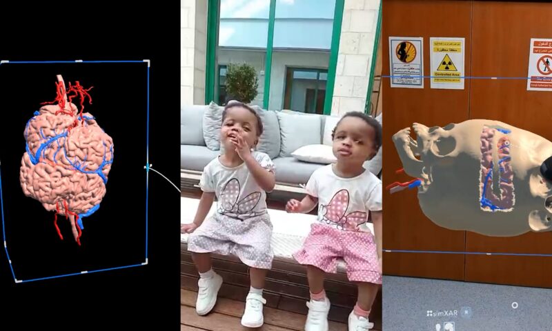 بمساعدة الذكاء الاصطناعي.. فصل توأم ملتصق في عملية جراحية معقدة استغرقت 40 ساعة