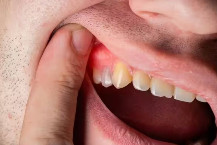 دليلك لصحة الفم .. أسباب التهاب اللثة وطرق علاجه
