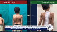 فريق طبي بجامعة أسيوط ينجح في إنقاذ حياة طفل من تشوه حاد بالعمود الفقري