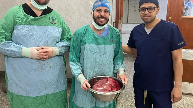 فريق طبي بجامعة أسيوط ينجح في استئصال ورم مبيضي ضخم لسيدة خمسينية