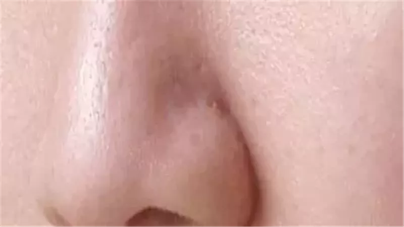 أسباب زيادة ظهور البثور السوداء بالبشرة فى الصيف