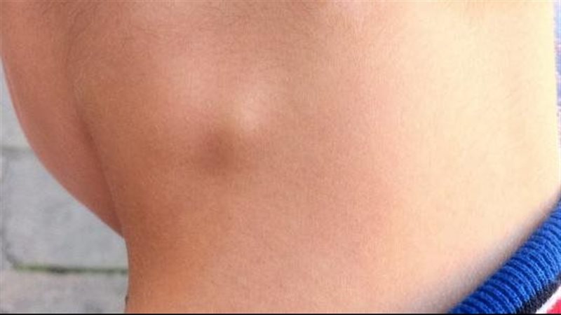 أسباب ظهور “كلكوعة” في رقبة طفلك أو خلف أذنه