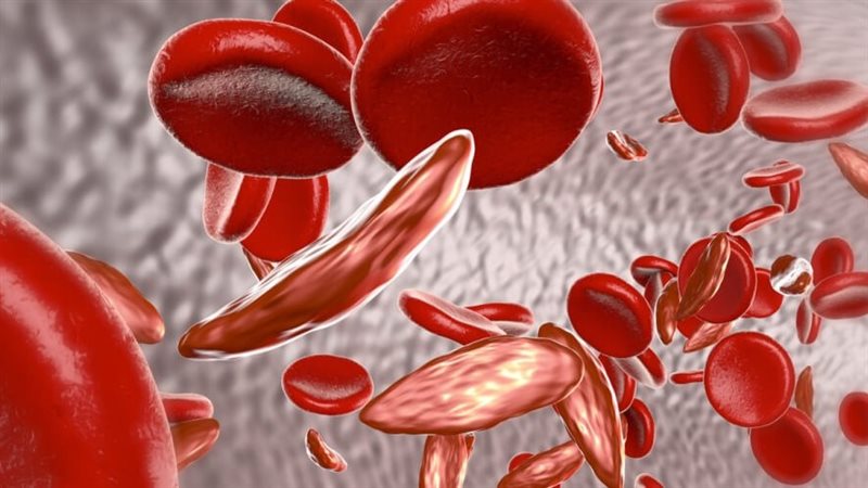 أعراض وأسباب الأنيميا المنجلية وطرق علاجها