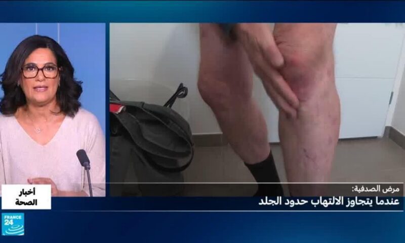 الصدفية.. كيف تؤثر على القلب والمفاصل؟
