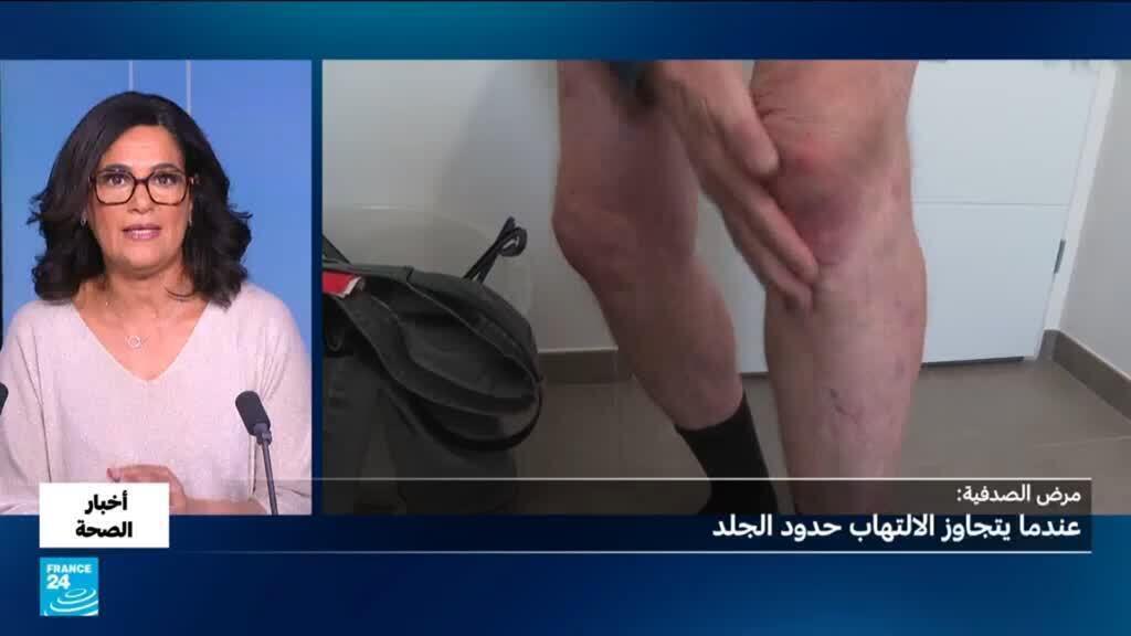 الصدفية.. كيف تؤثر على القلب والمفاصل؟