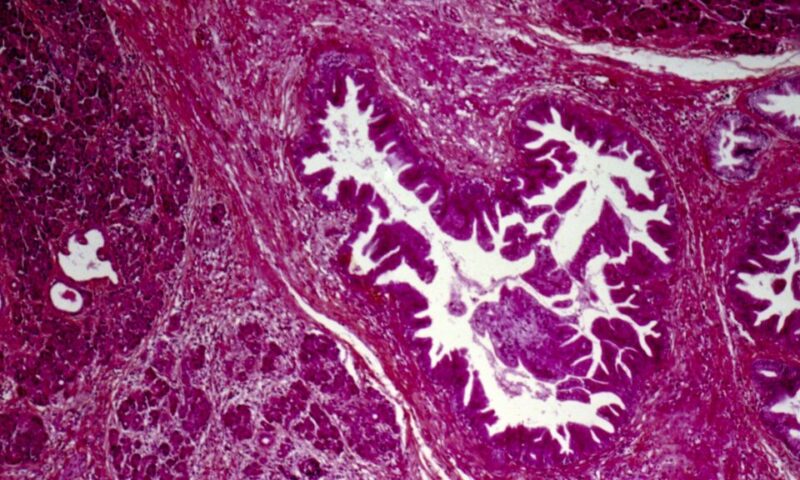 STAT+: A turning point for pancreatic cancer patients