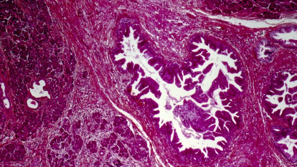 STAT+: A turning point for pancreatic cancer patients