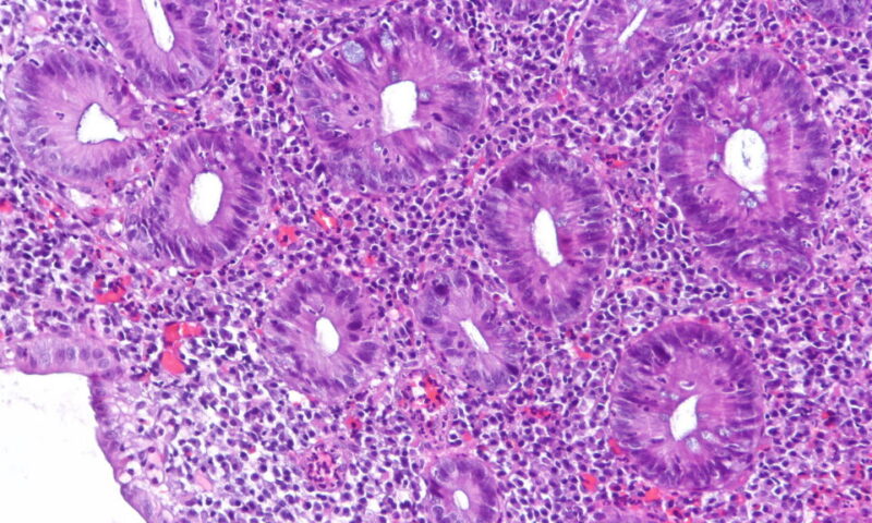 STAT+: Abivax ulcerative colitis drug shows strong efficacy, but cases of cancer raise concerns