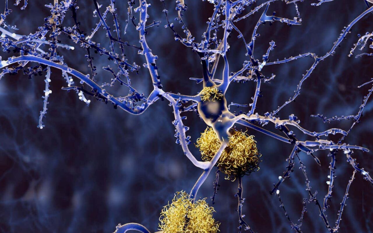Huge study of Alzheimer’s genetics identifies new drug targets
