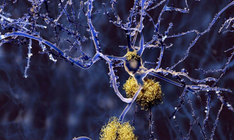 Huge study of Alzheimer’s genetics identifies new drug targets