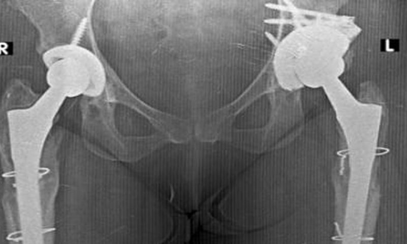 Infections, fractures increasingly driving repeat hip replacement surgeries, finds study