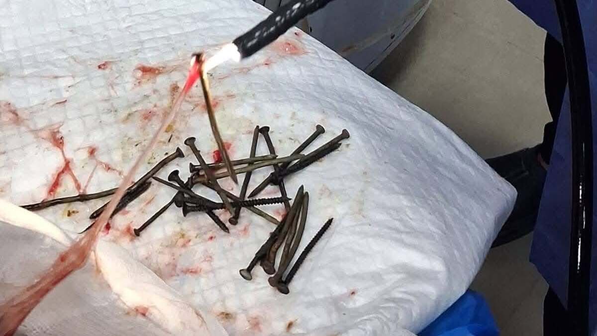 استخراج 100 مسمار من بطن مصري دون جراحة