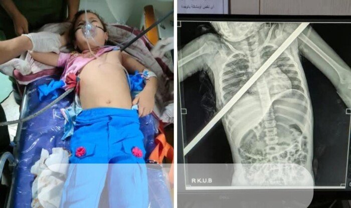إنقاذ طفلة اخترق صدرها سيخ حديدي في واقعة نادرة بمستشفيات بنها الجامعية