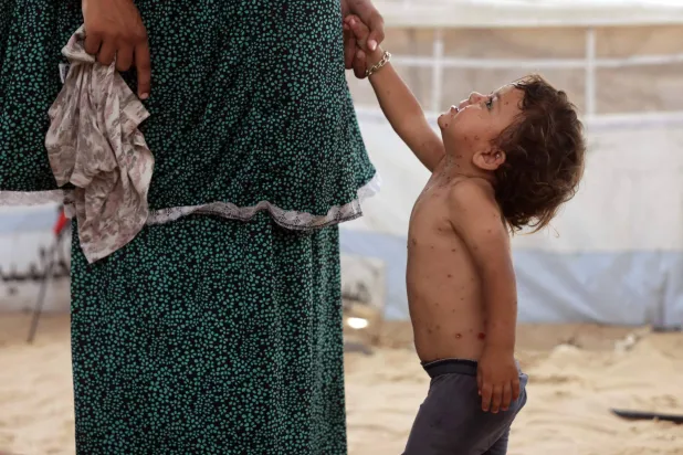 انتشار واسع للجدري بغزة يفاقم الأزمات الصحية المتلاحقة