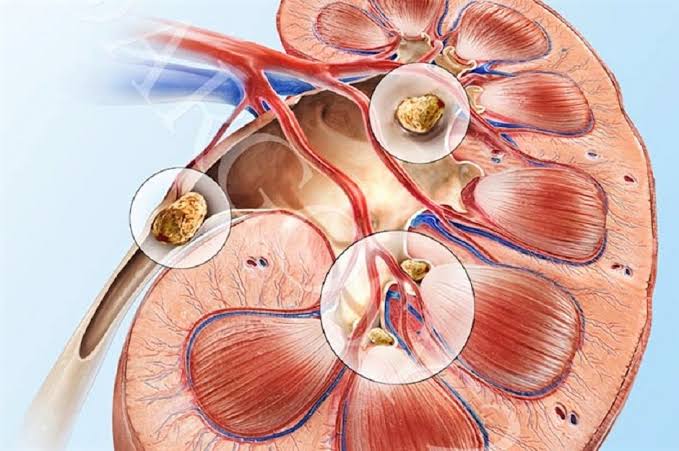 حصى الكلى.. إليك الأسباب والأعراض والعلاج